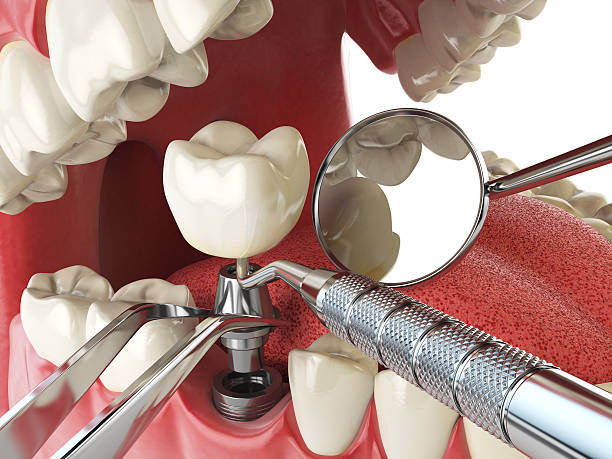 Best Emergency Treatment for Dental Infections or Abscesses in Villa Ridge, MO